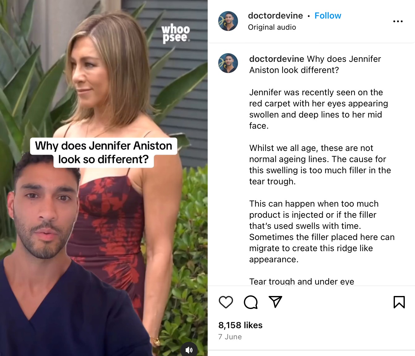 Dr. Richard Devine explained Jennifer Aniston’s failed cosmetic procedure 